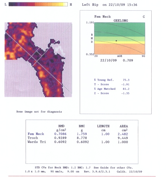 DEXA Scan